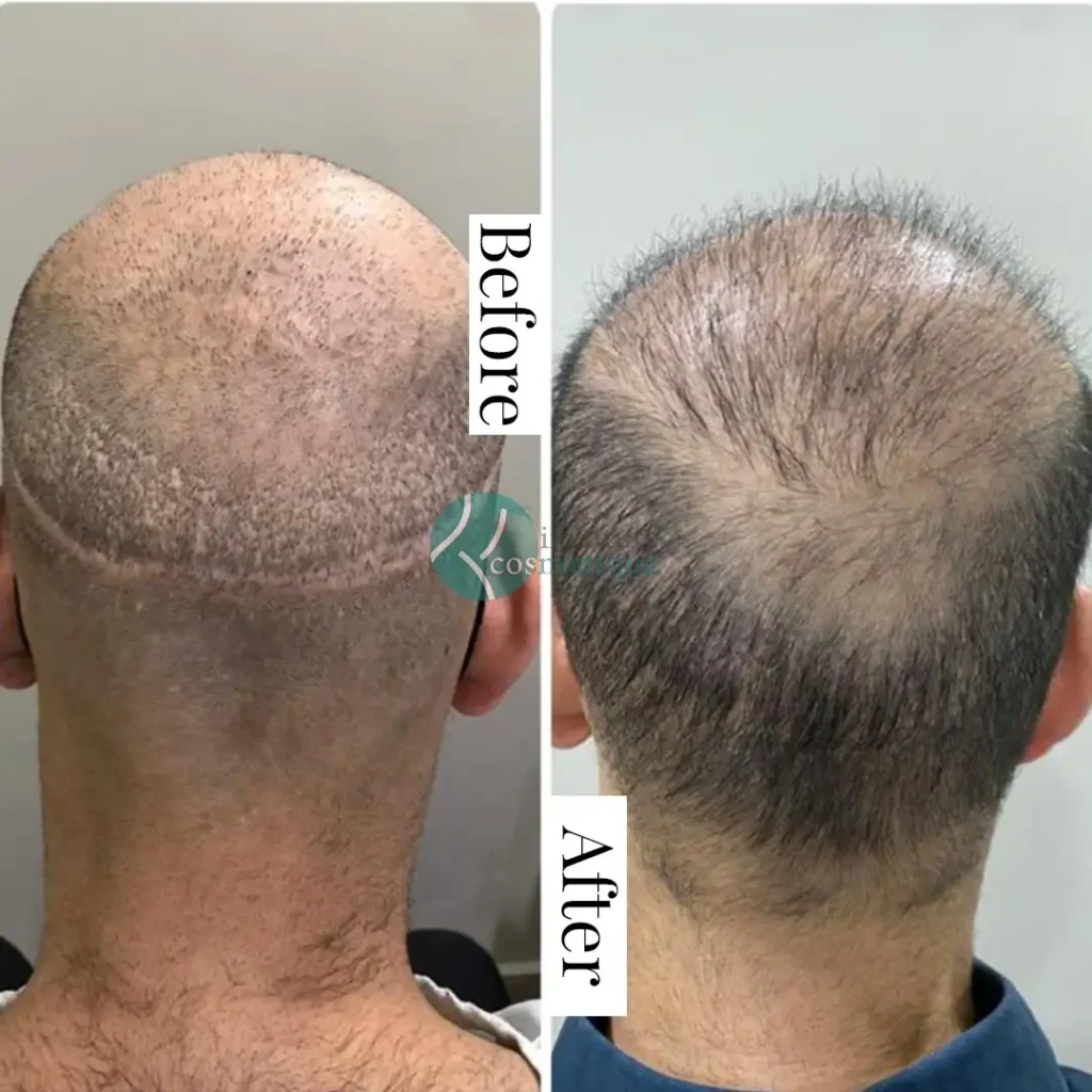 What Is the Best Hair Transplant Method?